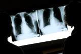 Gdańsk: Epidemia gruźlicy wśród pielęgniarek w szpitalu?