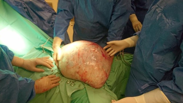 Ginekolodzy ze Szpitala Powiatowego w Oświęcimiu wycięli młodej pacjentce guza jajnika, który może ważyć nawet 30 kilogramów