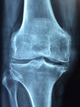 Sanok: Badania w kierunku osteoporozy. Sprawdź, czy jesteś zdrowy