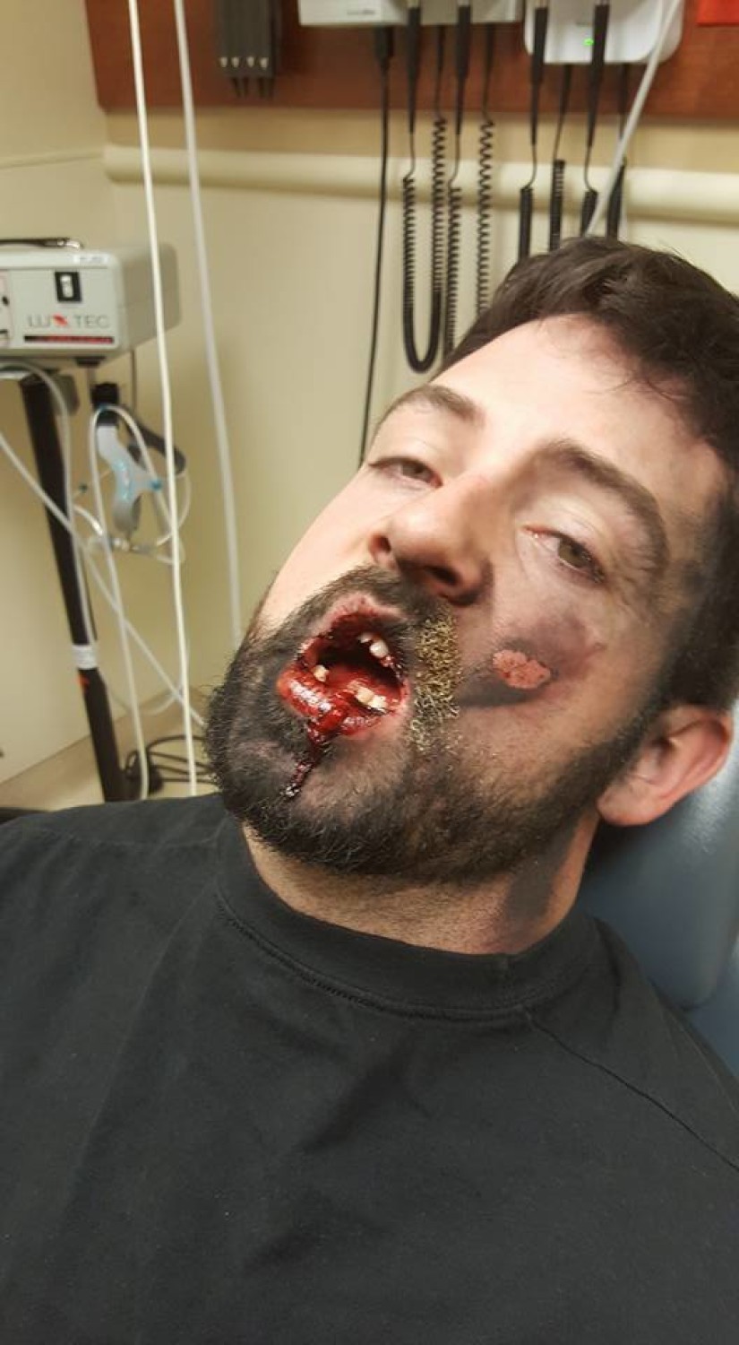 E-papieros eksplodował mu w ustach? Stracił kilka zębów i doznał licznych obrażeń. Zobacz zdjęcia.