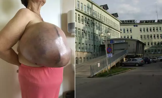 Guz w piersi kobiety ważył prawie 10 kg! Operacja, która odmieniła życie 64-latki odbyła się w Szpitalu Specjalistycznym w Jaśle