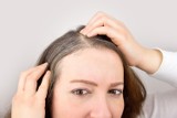 Wczesne siwienie może być oznaką choroby. Na co wskazuje wypadanie włosów i rozdwajające się końcówki? Które choroby widać na włosach?
