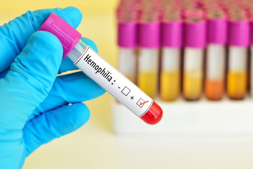 Hemofilia to skaza krwotoczna związana z niedoborem...