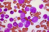 W Polsce pacjenci z przewlekłą białaczką limfocytową żyją krócej niż w Europie