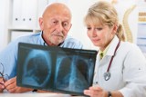 Pierwsze objawy raka płuca łatwo zignorować. Po tym rozpoznasz najczęściej występujący nowotwór złośliwy w Polsce. Zobacz, jak go leczyć