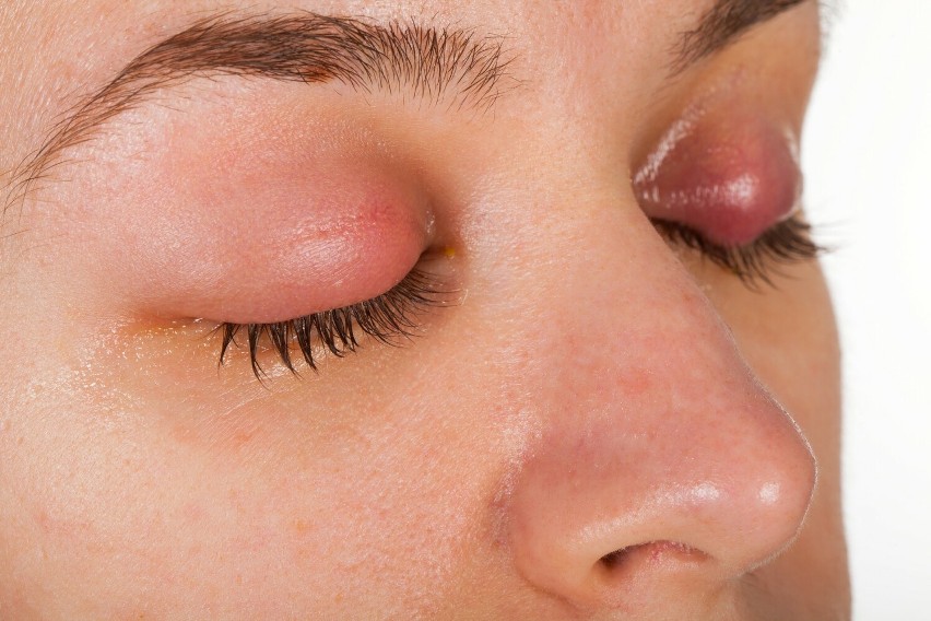 Żółta wydzielina w kąciku oka może być oznaką infekcji...