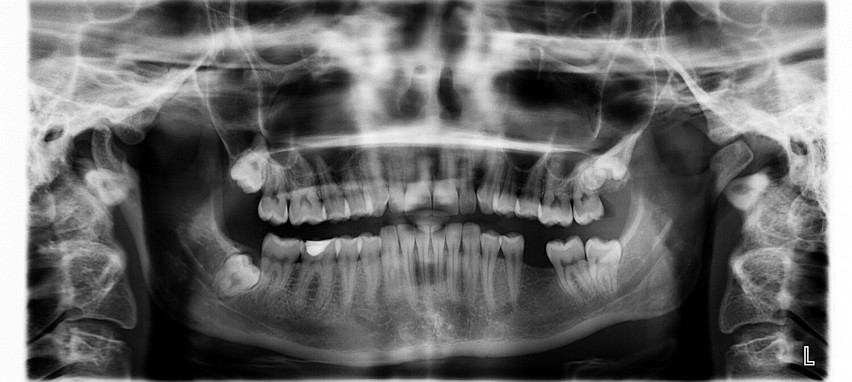 Zgrzytanie zębami może wskazywać na obecność pasożytów w...