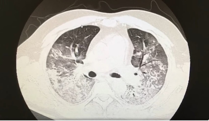 Zdjęcie 2 (tomografia płuc pacjenta z COVID-19)