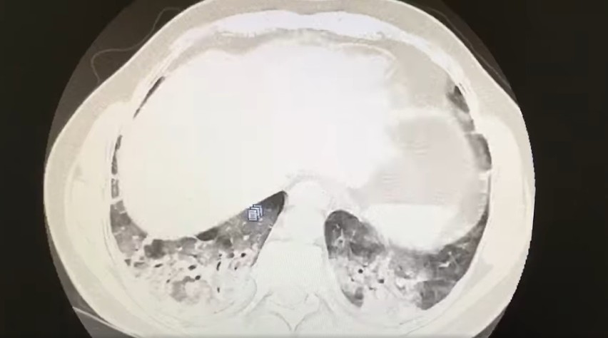 Zdjęcie 4 (tomografia płuc pacjenta z COVID-19)