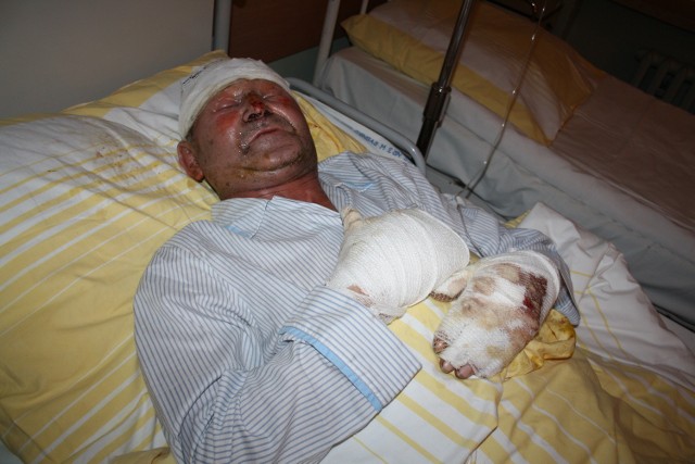 Roman Matyja z Krzywopłot leży w okluskim szpitalu. Ma poparzoną twarz i ręce, do tego nie może otworzyć oczu