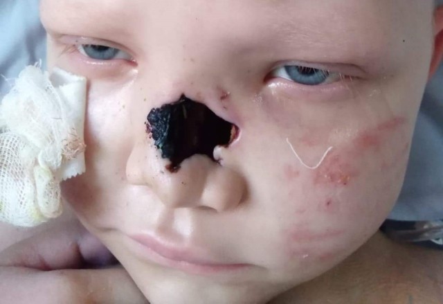 7-letnia Klaudia pokonała białaczkę, teraz czeka na rekonstrukcję nosa