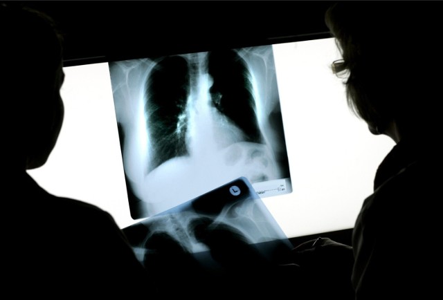 W ramach badań profilaktycznych swoje płuca mogą przebadać osoby, które paliły dużo i długo.