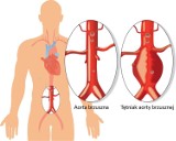 Zdrowa aorta - będzie można zrobić bezpłatne badania. Kto może z nich skorzystać?