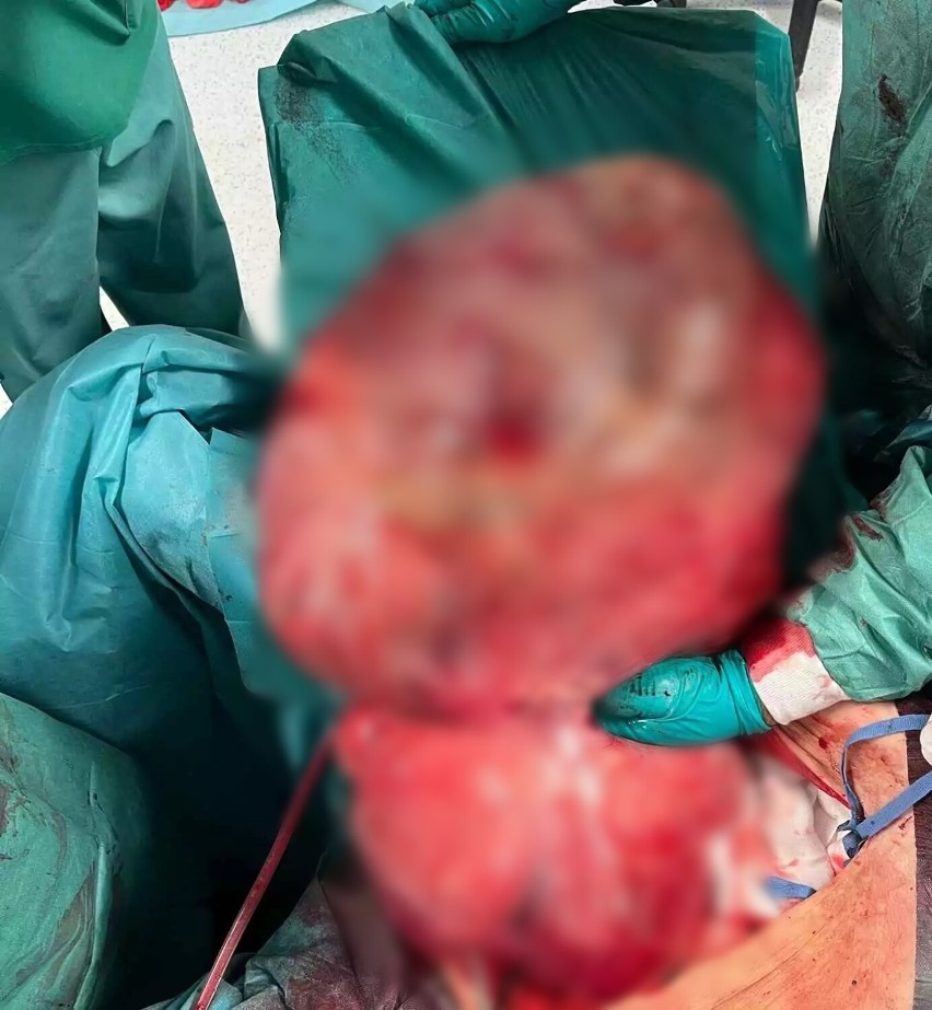 W szpitalu w Blachowni przeprowadzono operację usunięcia guza ważącego 26 kilogramów!
