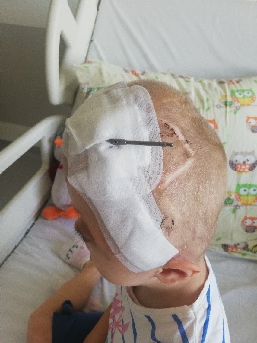 Unikalna operacja czaszki u 5-latki w Zdrojach! "Tosia to prawdziwa fighterka"  [ZDJĘCIA, WIDEO]