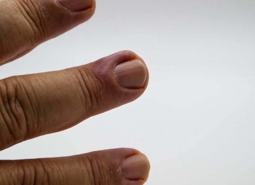 Zanokcica (zapalenie wału paznokciowego)