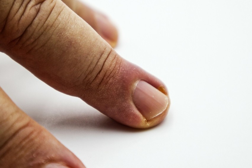Zanokcica opryszczkowa to infekcja wału paznokciowego...