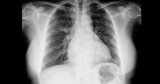 Jak Omikron wpływa na płuca? Optymistyczne wyniki badań