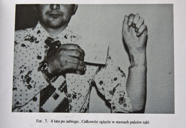 Józef Maszkiewicz pokazuje rękę przyszytą przez chirurgów w Trzebnicy