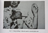 50 lat temu, w szpitalu w Trzebnicy koło Wrocławia, po raz pierwszy przyszyto w Polsce odciętą rękę (ZDJĘCIA)