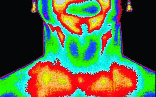 Tarczyca na zdjęciu termograficznym. Gruczoł jest mocno ukrwiony, w minutę przepływa przez niego około 5 litrów krwi