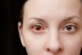 Objaw Omikronu widoczny w oczach może być jedynym symptomem zakażenia koronawirusem. Lekarz podpowiada jak go rozpoznać