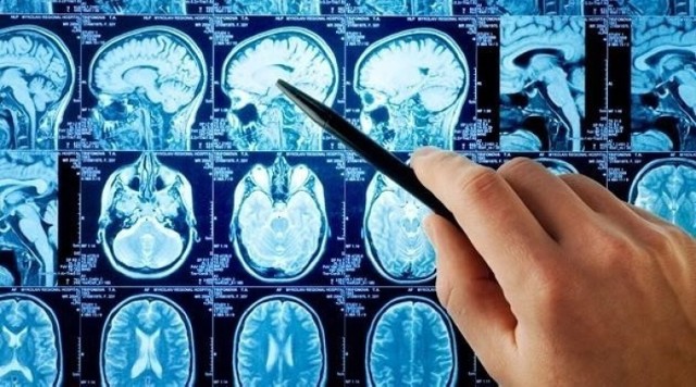 Stwardnienie rozsiane (łac. sclerosis multiplex - SM). Ta nieuleczalna choroba neurologiczna o nieznanym pochodzeniu dotyka w Polsce wiele tysięcy osób. Należy do tzw. chorób autoimmunologicznych. Na SM tak naprawdę może zachorować każdy. Jakie objawy powinny nas zaniepokoić?

>>>>>>>>>CZYTAJ DALEJ