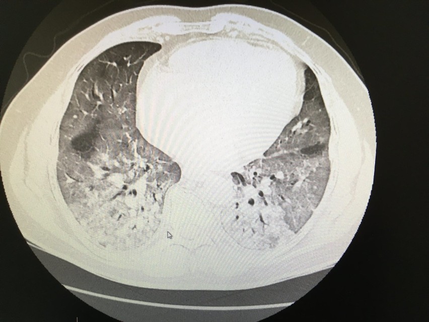 Zdjęcie płuc 44-letniego pacjenta, bez chorób...