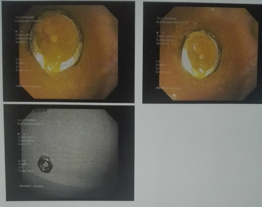 LUBUSKIE. Dziecko połknęło „baterię”, szpital odesłał je do domu. Rodzice mówią: przeżyliśmy horror! I opowiadają nam swoją historię