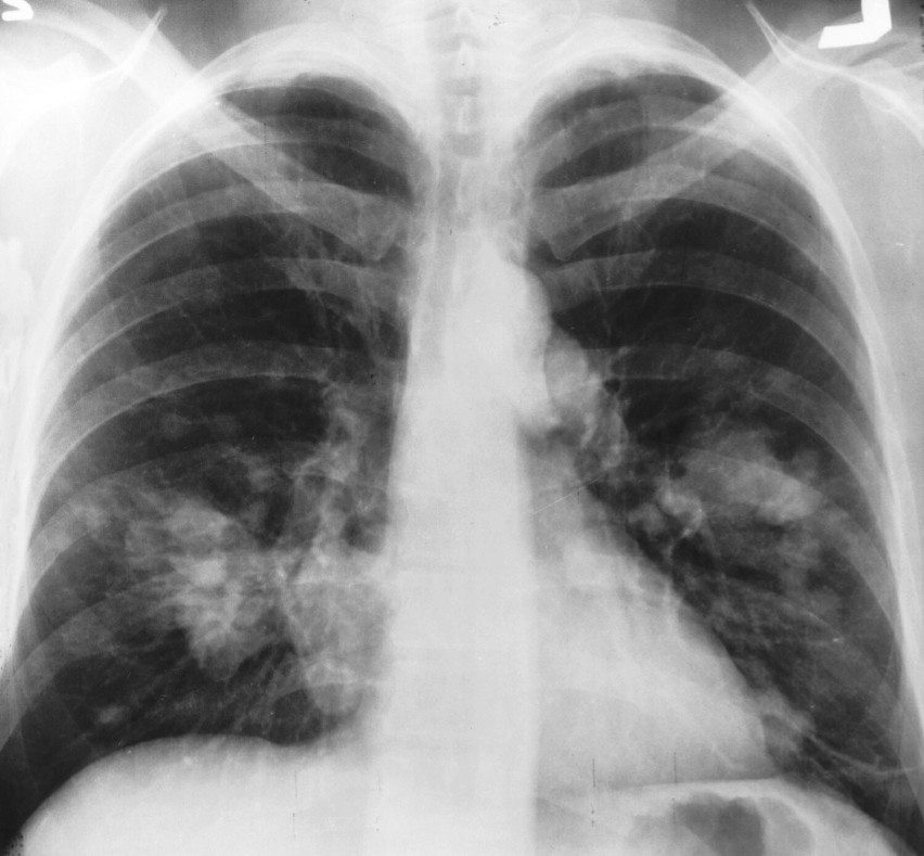 Rak płuc w dzisiejszych czasach to jeden z najczęstszych...