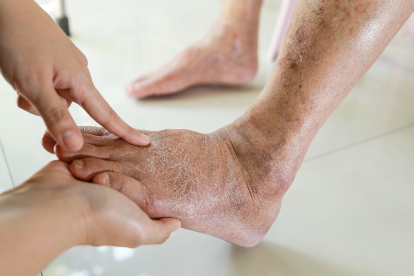 Osoba z początkami choroby Alzheimera może nie zdawać sobie...