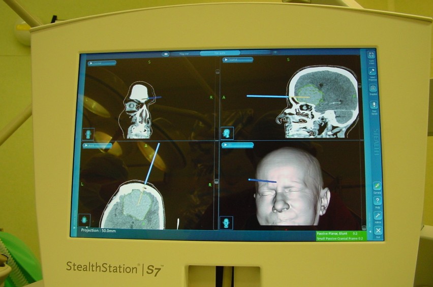Bytomscy neurochirurdzy mają neuronawigację
