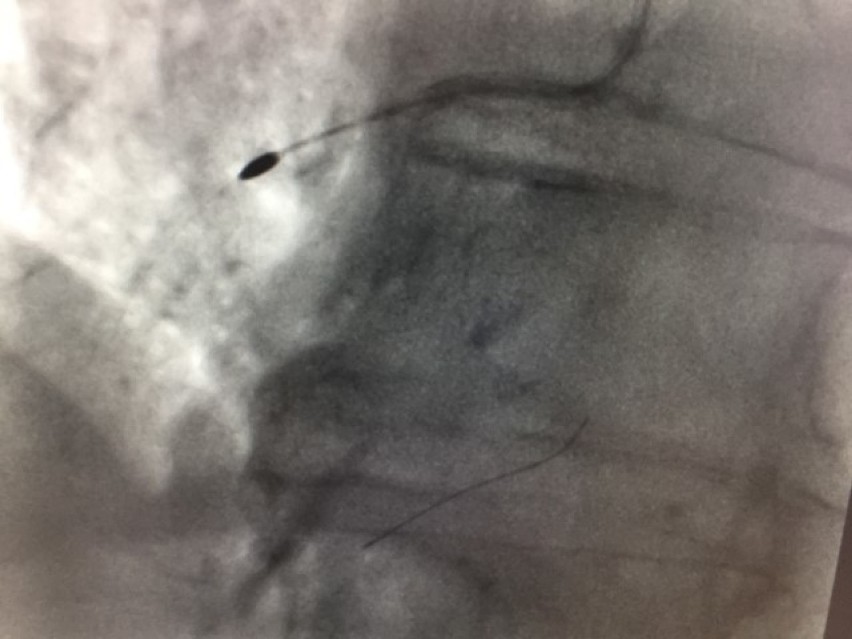Kardiolodzy pierwszy raz w Wejherowie przeprowadzili zabieg rotablacji wieńcowej