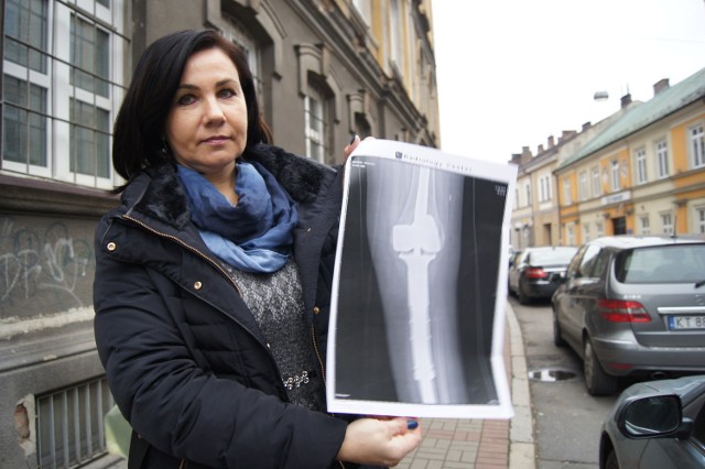 Bożena Miczek ze zdjęciem rentgenowskim endoprotezy, która ma zapobiec amputacji nogi Sebastiana