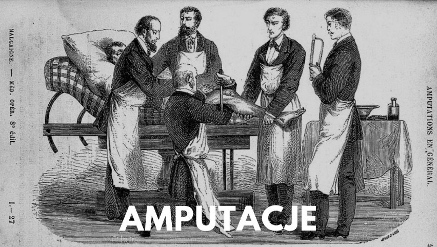 Amputacja kończyn to jeden z najstarszych znanych zabiegów....