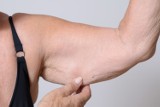 Obwisłe ramiona to wstydliwy problem. Zobacz, jak pozbyć się obwisłej skóry na rękach? Oto lista skutecznych ćwiczeń i zabiegów