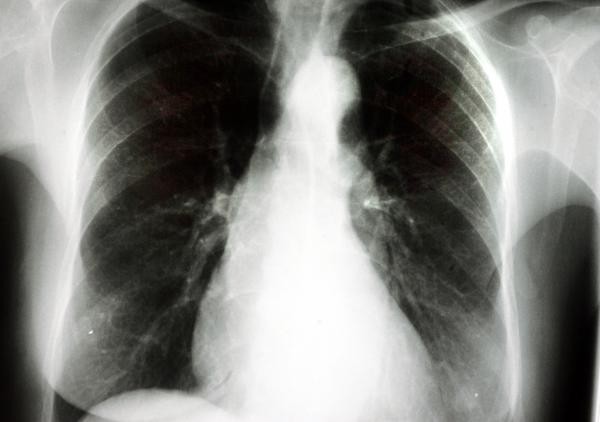 1. Zdrowie

Ryzyko zachorowania na raka płuc jest u palaczy...