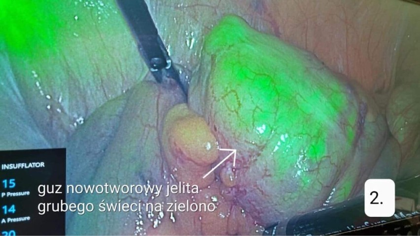 W kaliskim szpitalu operowano na… zielono. To pierwszy taki zabieg w historii kaliskiej chirurgii. ZDJĘCIA