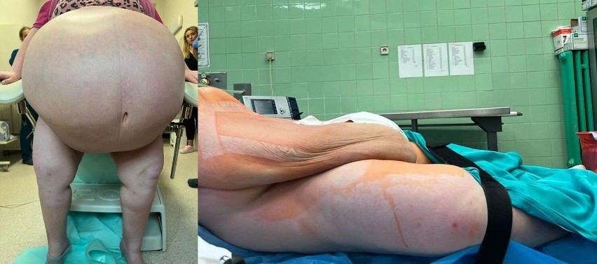Prawie 100-kilogramową cystę u 24-letniej pacjentki usunęli lekarze z Uniwersyteckiego Szpitala Klinicznego w Rzeszowie 