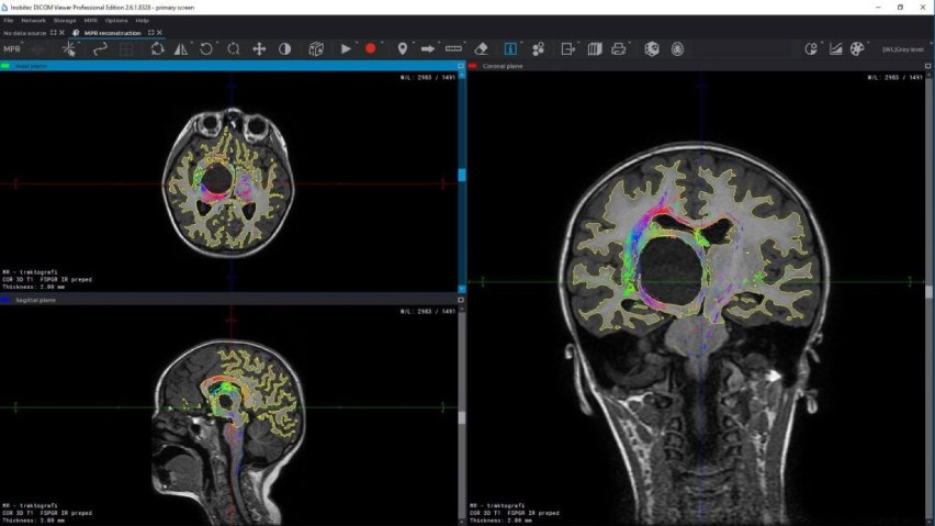 Model mózgu z drukarki 3D