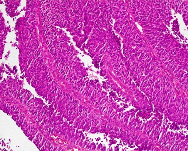 Źródło: http://commons.wikimedia.org/wiki/File:Urothelial_papillary_carcinoma_highly_differentiated_%28urinary_bladder%29H%26E_magn_200x.jpg