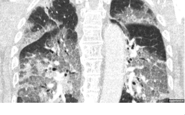 Holenderskie Centrum Medyczne Zuyderland opublikowało zdjęcie rentgenowskie płuc pacjenta z Covid-19. Ku przestrodze. Zobaczcie na zdjęciach jak dramatyczny jest ich stan po przejściu koronawirusa!

WIĘCEJ NA KOLEJNYCH STRONACH>>>