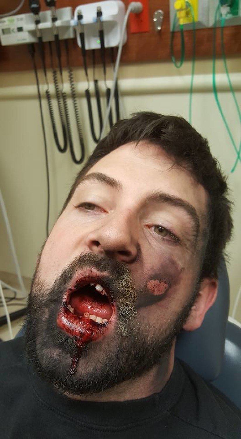 E-papieros eksplodował mu w ustach? Stracił kilka zębów i doznał licznych obrażeń. Zobacz zdjęcia.