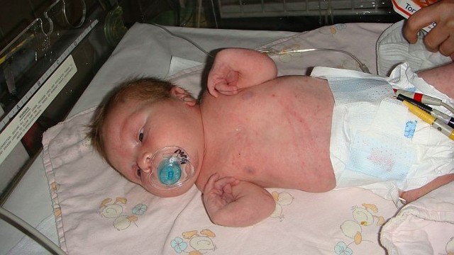 Krystian urodził się z zespołem TAR - rzadką chorobą, która dotyka jedno na 200 tysięcy dzieci