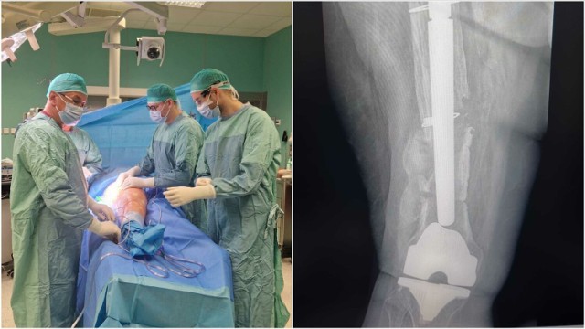 Sukcesem zakończyła się skomplikowana operacja ortopedyczna jednej z pacjentek szpitala im. Szczeklika w Tarnowie