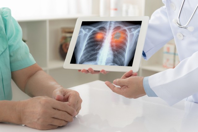 Rak płuc zwykle diagnozowany jest zbyt późno. Poznaj wczesne objawy raka płuc, aby w porę rozpoznać chorobę i podjąć odpowiednie leczenie! 

Zobacz kolejne slajdy, przesuwając zdjęcia w prawo, naciśnij strzałkę lub przycisk NASTĘPNE.