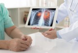 Nie ignoruj wczesnych objawów raka płuc! Po tym rozpoznasz najczęściej występujący nowotwór złośliwy w Polsce. Zobacz, jak go leczyć