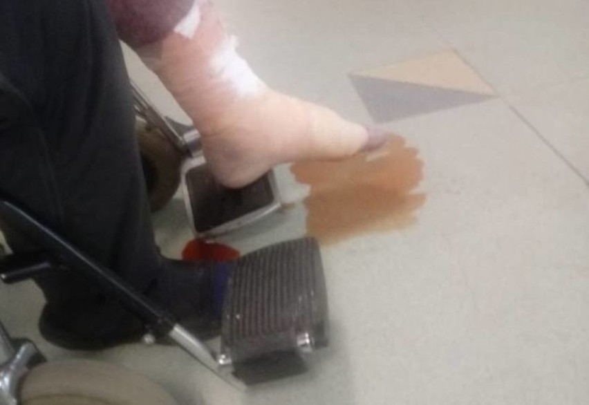 Z bolącej, sinej nogi 39-letniego mężczyzny sączyła się krew...