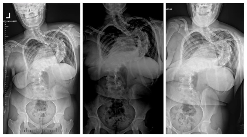 Młoda tomaszowianka przeszła innowacyjną operację kręgosłupa. "Urosła" aż o 16 cm [ZDJĘCIA]