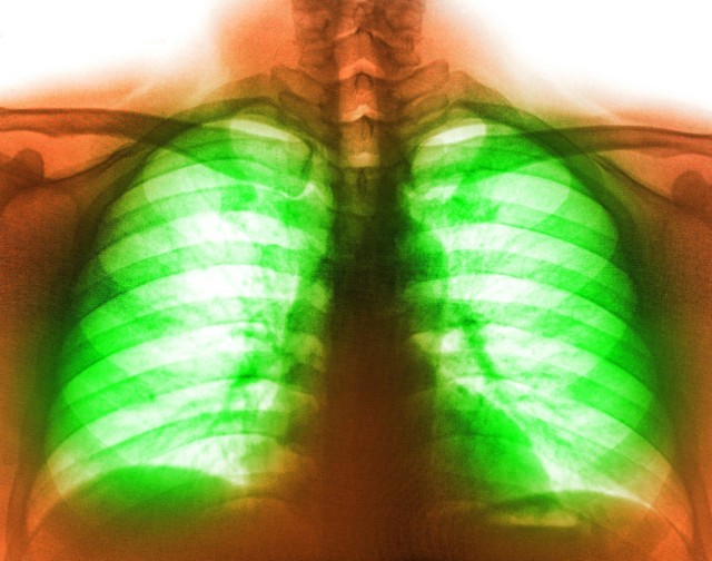Prątki gruźlicy w większości przypadków atakują płuca – inne postaci choroby rozpoznaje się tylko u niespełna 5 proc. osób zakażonych.
